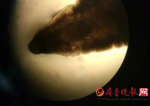 杭州女子体内取出密密麻麻黑虫能在人体存活2