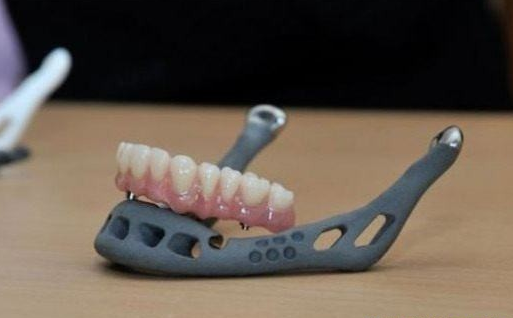 解析3D打印在口腔种植导板制作中的应用研究