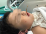 13厘米竹签扎进两岁女童口腔　11个学科团队联手救命