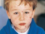 孩子发热并伴有红色皮疹 谨防感染麻疹
